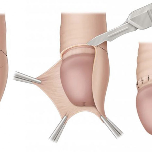 Does Circumcision Impact Physical Sexual Sensitivity?